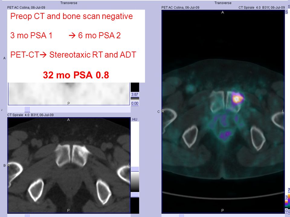 Preop CT and bone scan negative 3 mo PSA 1  6 mo PSA 2 PET-CT  Stereotaxic RT and ADT 32 mo PSA 0.8