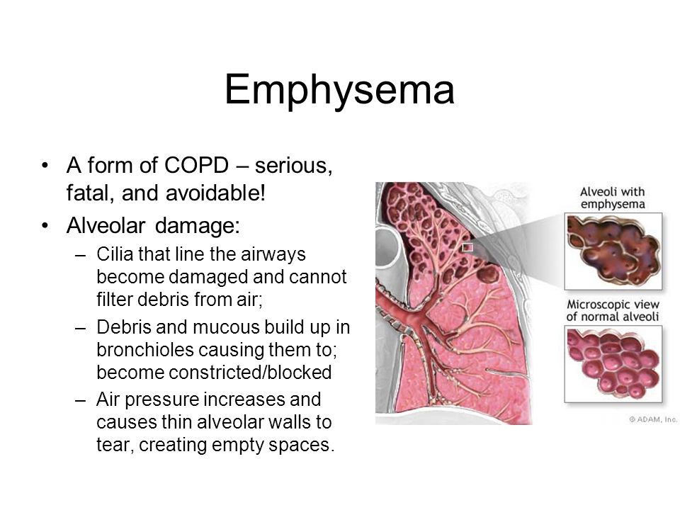 Emphysema A form of COPD – serious, fatal, and avoidable.