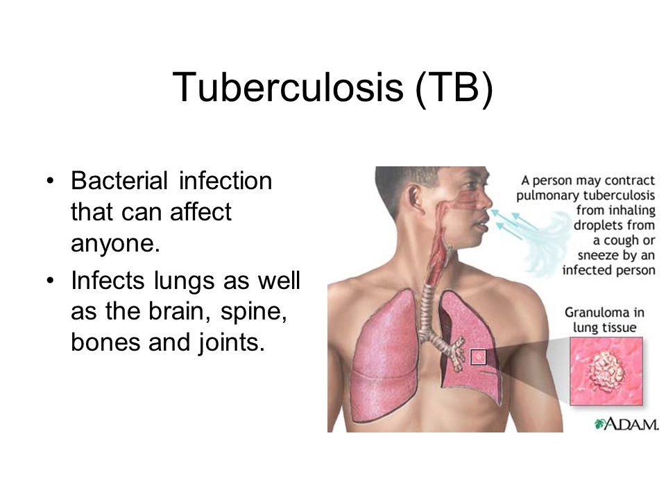 Tuberculosis (TB) Bacterial infection that can affect anyone.