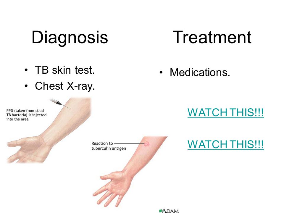 Diagnosis TB skin test. Chest X-ray. Treatment Medications. WATCH THIS!!!