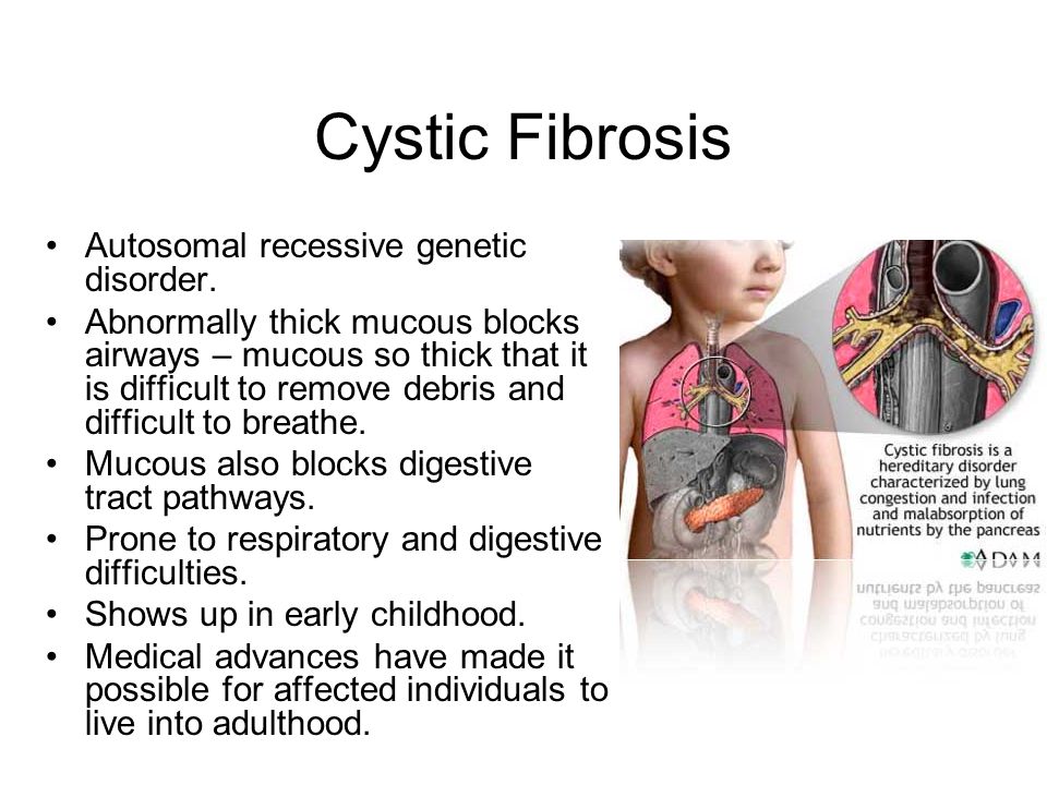 Cystic Fibrosis Autosomal recessive genetic disorder.