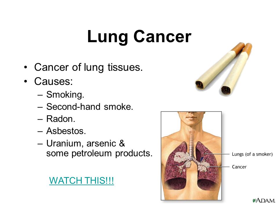 Lung Cancer Cancer of lung tissues. Causes: –Smoking.