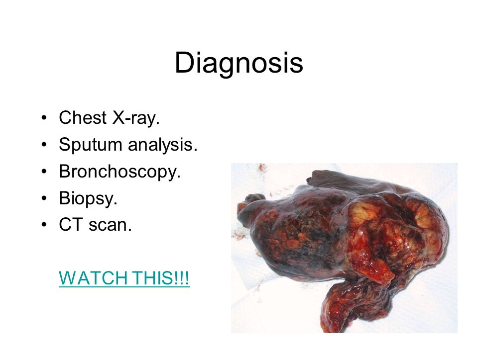 Diagnosis Chest X-ray. Sputum analysis. Bronchoscopy. Biopsy. CT scan. WATCH THIS!!!