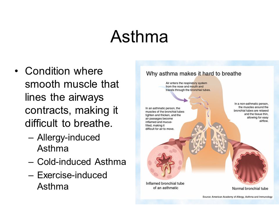 Asthma Condition where smooth muscle that lines the airways contracts, making it difficult to breathe.