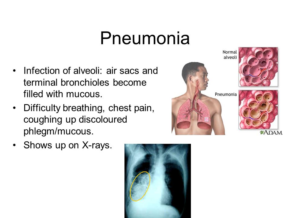 Pneumonia Infection of alveoli: air sacs and terminal bronchioles become filled with mucous.