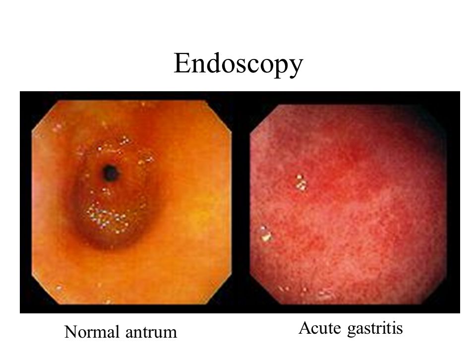 What are the stomach symptoms of gastritis in the antrum?