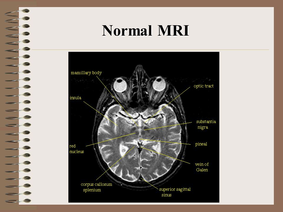 Normal MRI