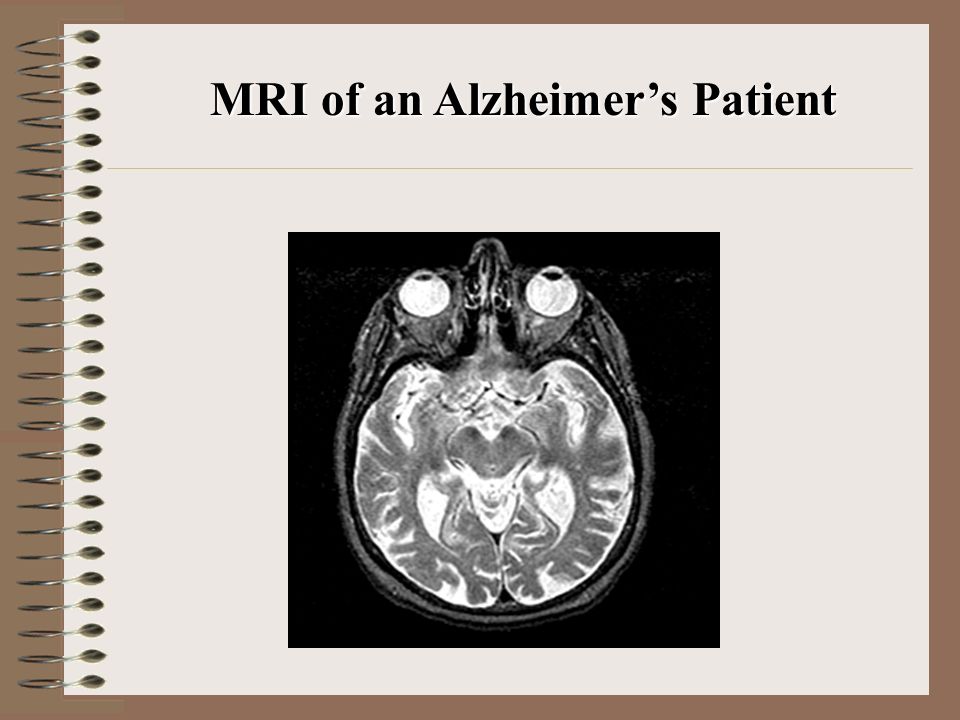 MRI of an Alzheimer’s Patient