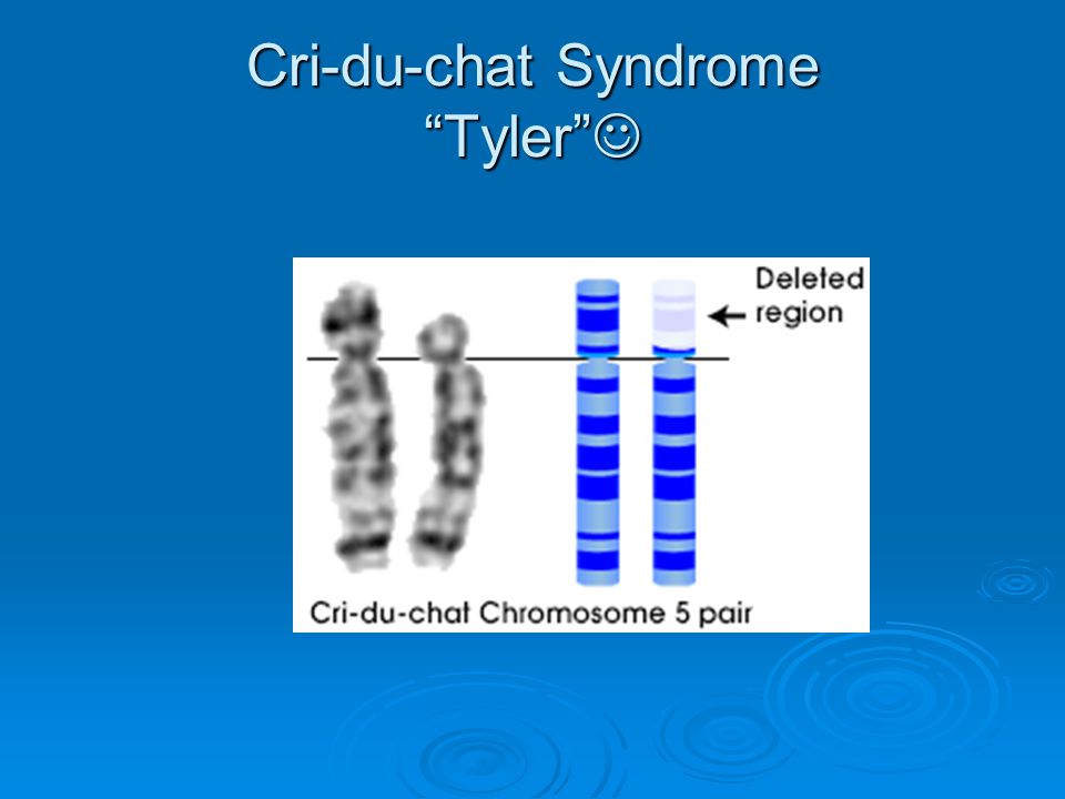 Cri-du-chat Syndrome Tyler Cri-du-chat Syndrome Tyler
