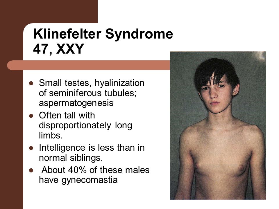 the symptoms and effects of klinefelter syndrome a genetic disorder affecting males Klinefelter syndrome is a chromosome disorder affecting males in which men with the condition have an extra x chromosome. the symptoms and effects of klinefelter syndrome a genetic disorder affecting males Klinefelter syndrome is a chromosome disorder affecting males in which men with the condition have an extra x chromosome.