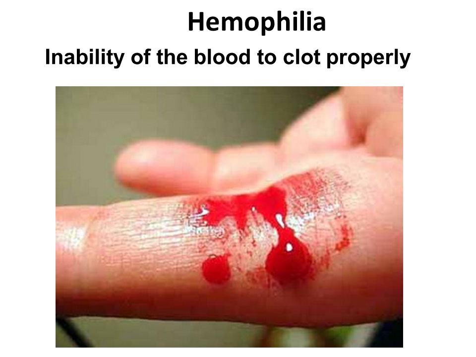 Hemophilia Inability of the blood to clot properly