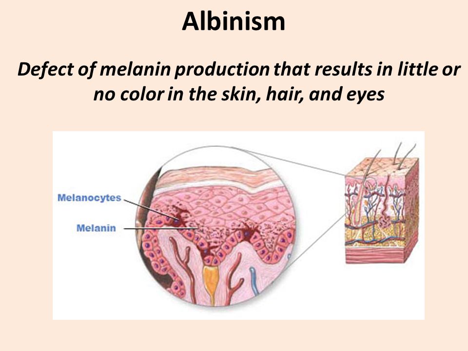 Albinism Defect of melanin production that results in little or no color in the skin, hair, and eyes