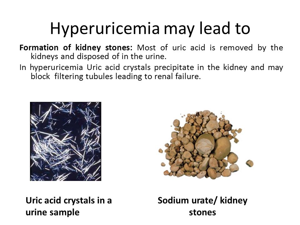 Viagra And Uric Acid Stones