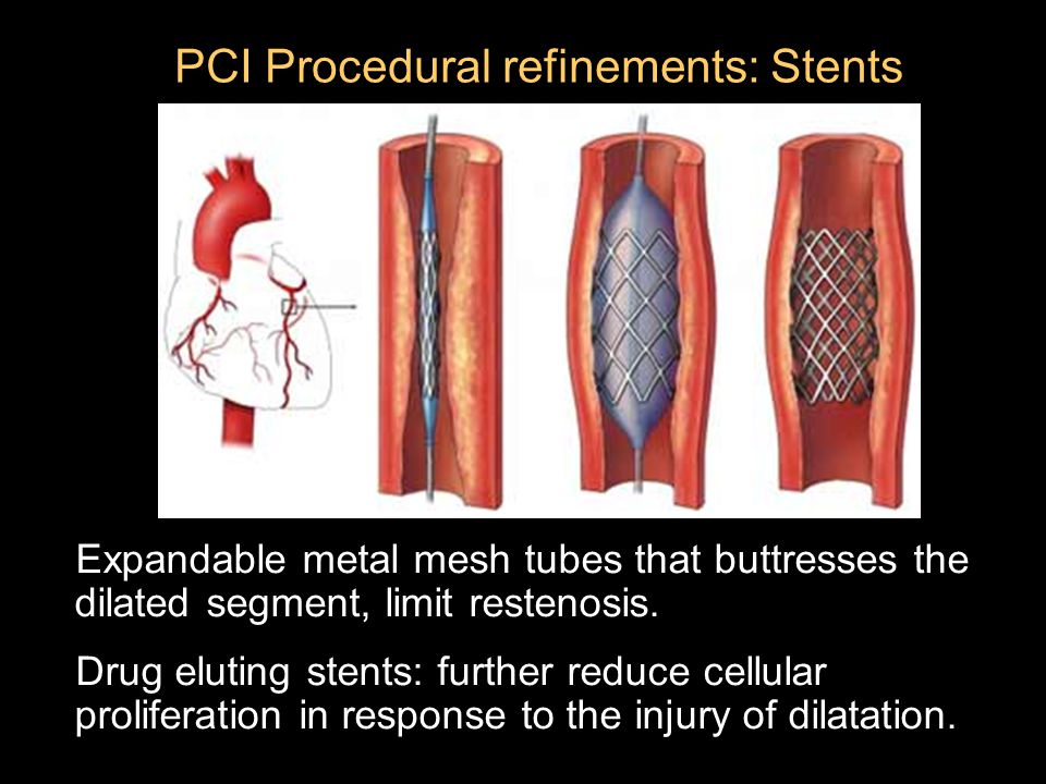 PCI Procedural refinements: Stents Expandable metal mesh tubes that buttresses the dilated segment, limit restenosis.