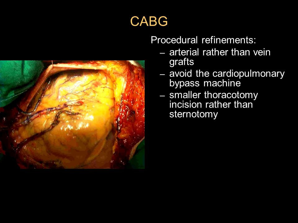 CABG Procedural refinements: – arterial rather than vein grafts – avoid the cardiopulmonary bypass machine – smaller thoracotomy incision rather than sternotomy