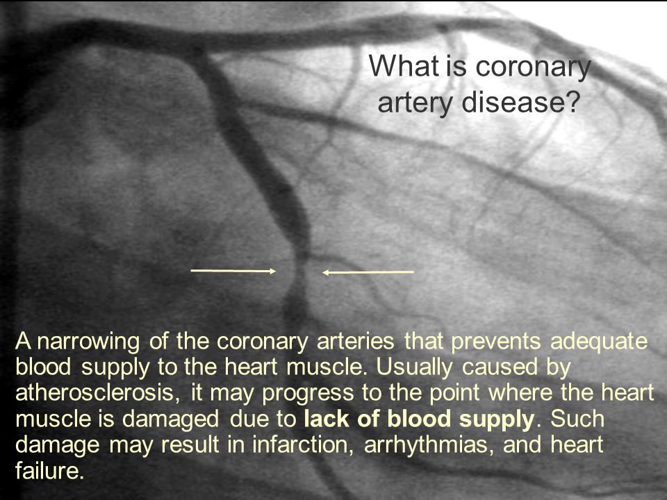 What is coronary artery disease.