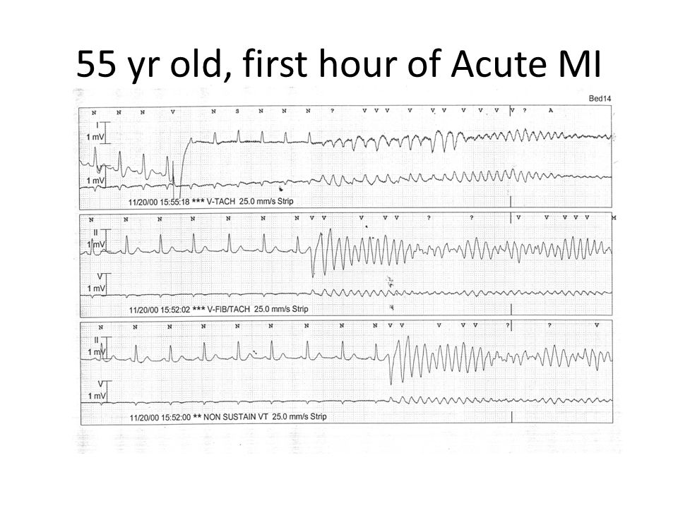 55 yr old, first hour of Acute MI