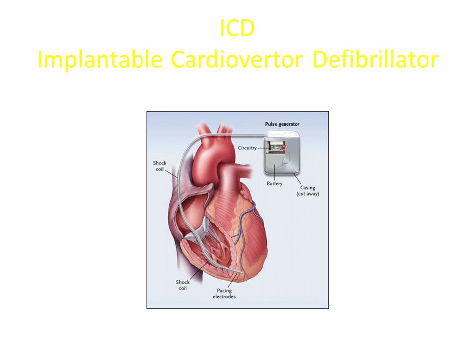 ICD Implantable Cardiovertor Defibrillator