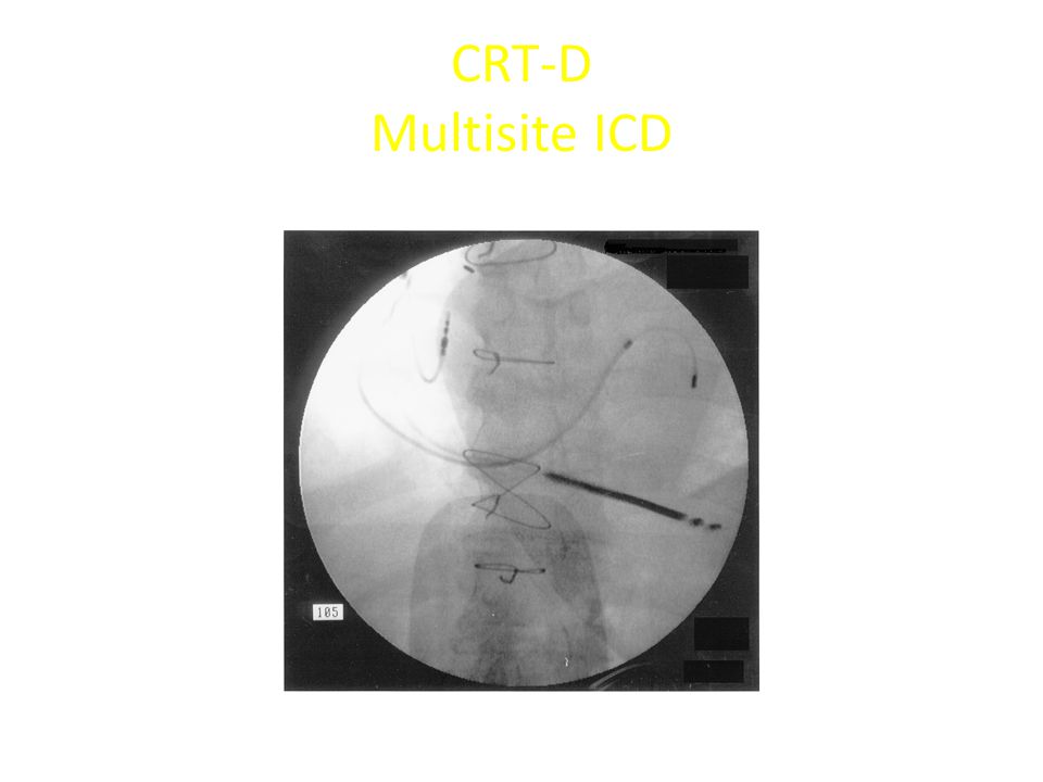 CRT-D Multisite ICD