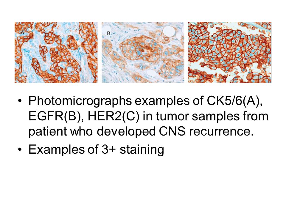 Photomicrographs examples of CK5/6(A), EGFR(B), HER2(C) in tumor samples from patient who developed CNS recurrence.