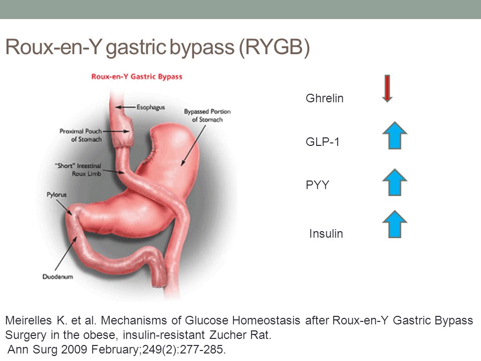 Ghrelin and gastric bypass surgery
