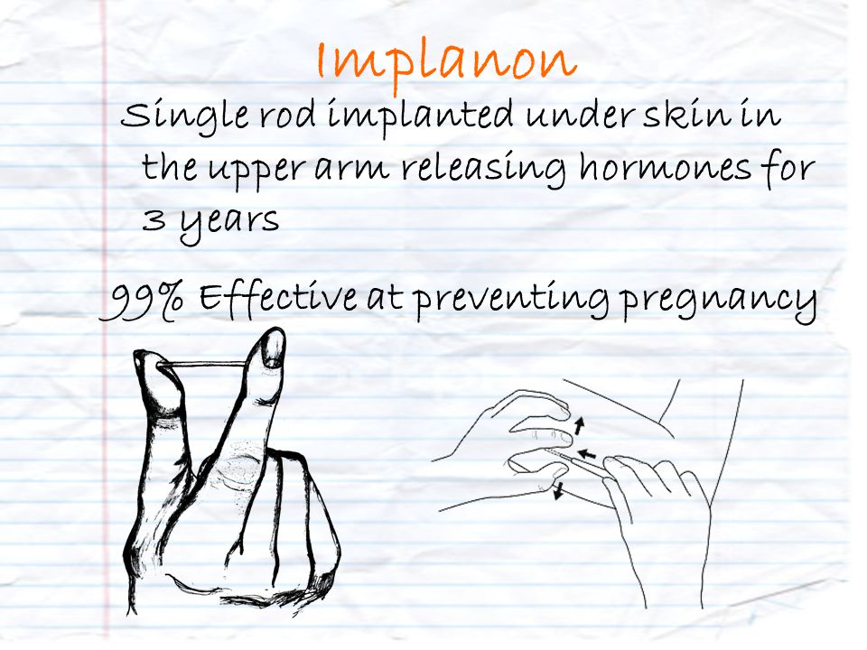 Implanon Single rod implanted under skin in the upper arm releasing hormones for 3 years 99% Effective at preventing pregnancy