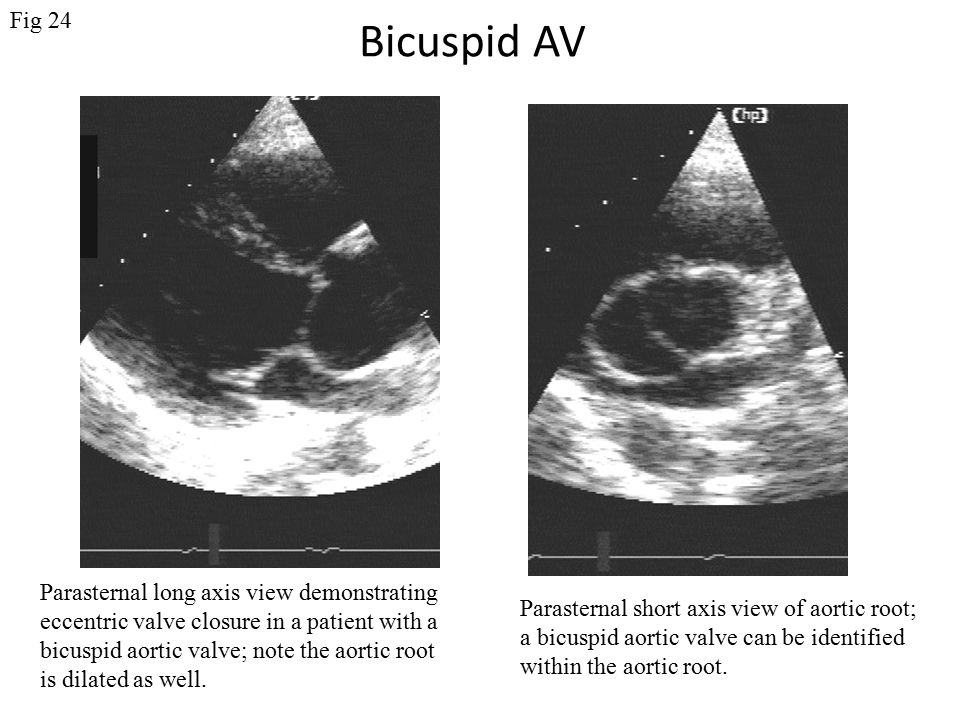 Bicuspid AV Parasternal long axis view demonstrating eccentric valve closure in a patient with a bicuspid aortic valve; note the aortic root is dilated as well.
