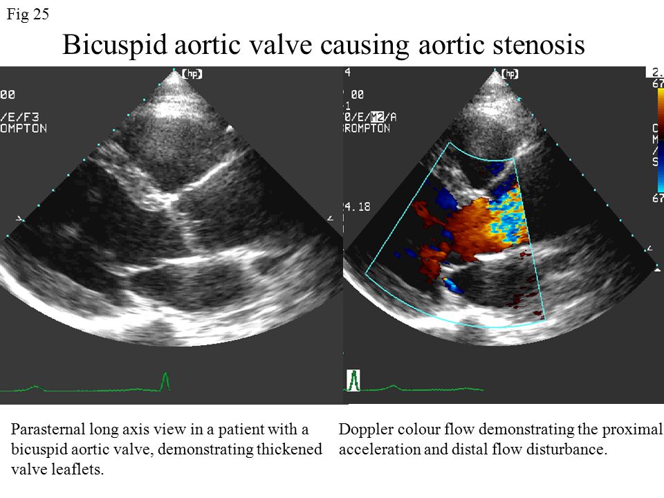 Bicuspid aortic valve causing aortic stenosis Parasternal long axis view in a patient with a bicuspid aortic valve, demonstrating thickened valve leaflets.