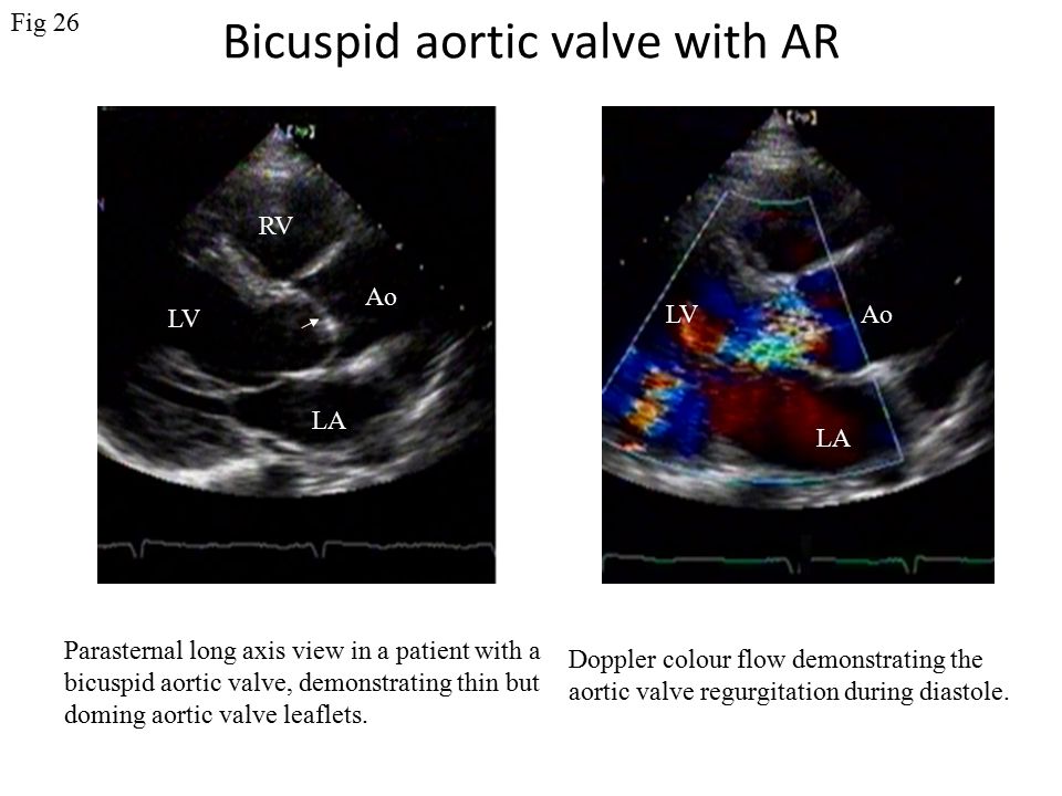 Bicuspid aortic valve with AR Parasternal long axis view in a patient with a bicuspid aortic valve, demonstrating thin but doming aortic valve leaflets.