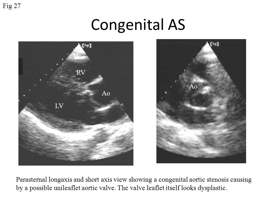 Congenital AS Parasternal longaxis and short axis view showing a congenital aortic stenosis causing by a possible unileaflet aortic valve.