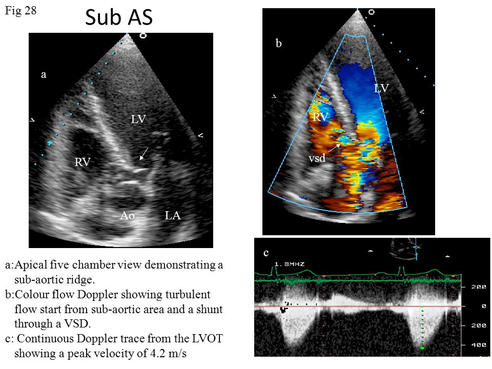 Sub AS a b c LV RV AoLA LV vsd RV a:Apical five chamber view demonstrating a sub-aortic ridge.