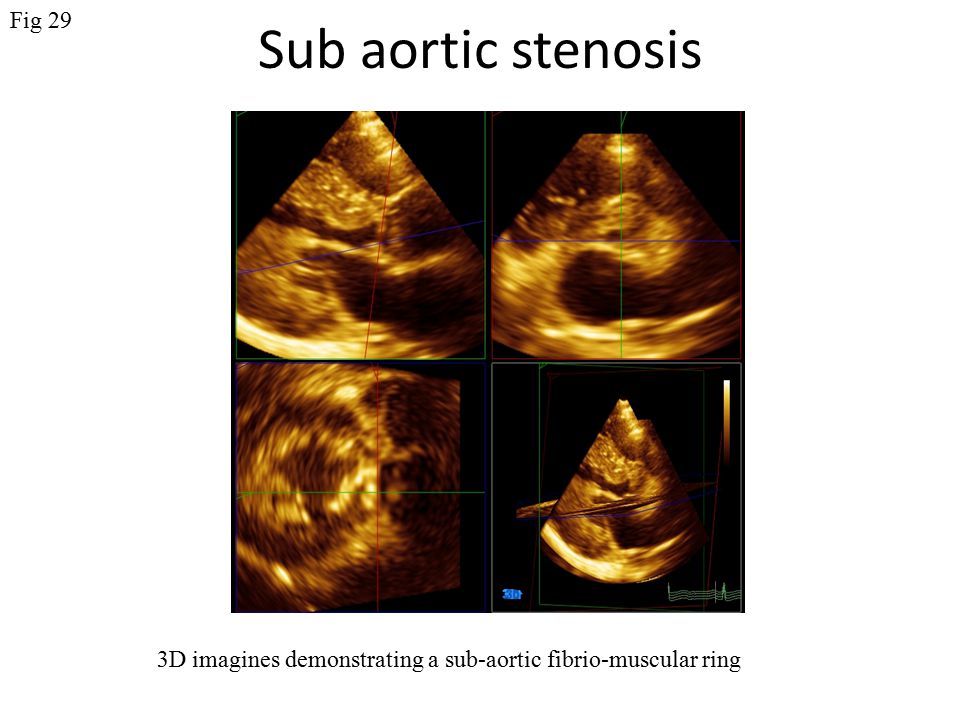 Sub aortic stenosis 3D imagines demonstrating a sub-aortic fibrio-muscular ring LV Ao Fig 29