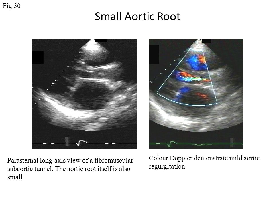 Small Aortic Root Parasternal long-axis view of a fibromuscular subaortic tunnel.