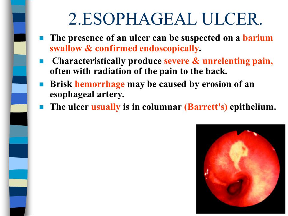 Erosion esophagus