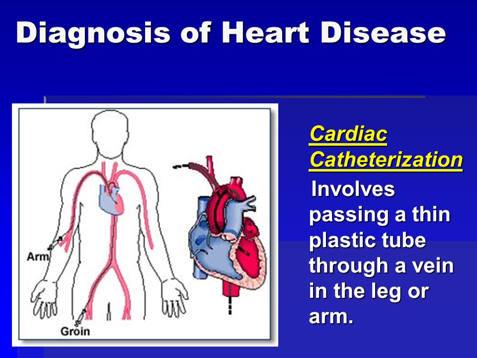 Diagnosis of Heart Disease Cardiac Catheterization Cardiac Catheterization Involves passing a thin plastic tube through a vein in the leg or arm.