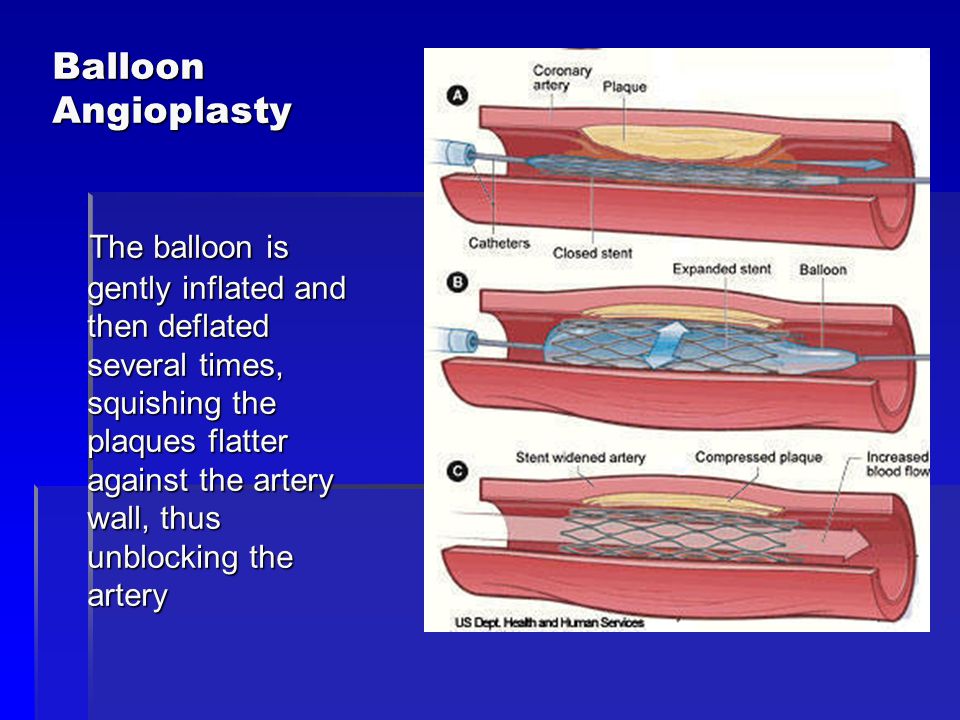 Balloon Angioplasty The balloon is gently inflated and then deflated several times, squishing the plaques flatter against the artery wall, thus unblocking the artery