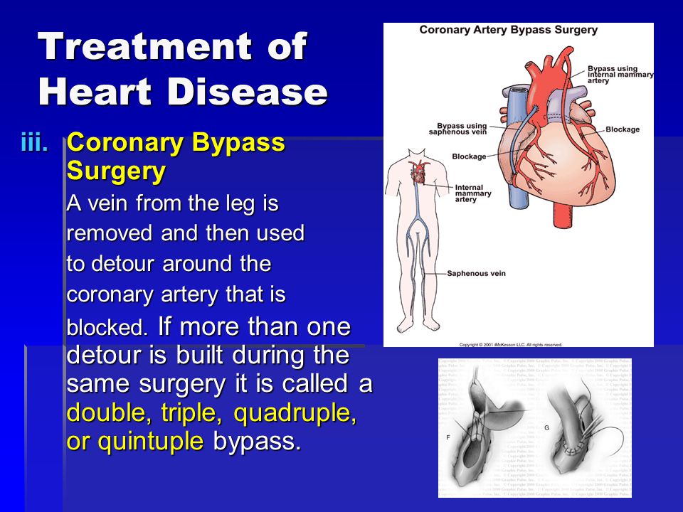 Treatment of Heart Disease iii.