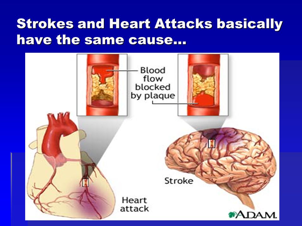 Strokes and Heart Attacks basically have the same cause…