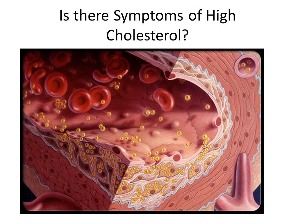 Is there Symptoms of High Cholesterol