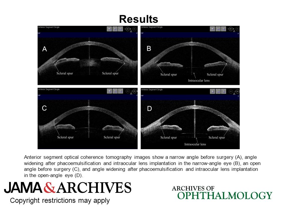Results Copyright restrictions may apply Anterior segment optical coherence tomography images show a narrow angle before surgery (A), angle widening after phacoemulsification and intraocular lens implantation in the narrow-angle eye (B), an open angle before surgery (C), and angle widening after phacoemulsification and intraocular lens implantation in the open-angle eye (D).