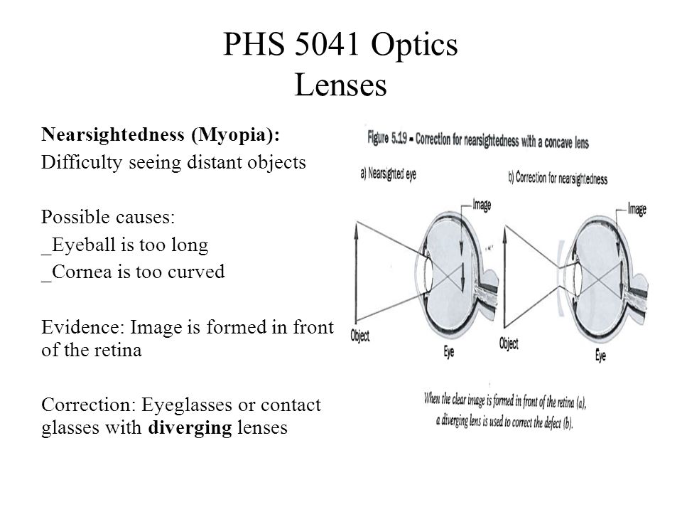 PHS 5041 Optics Lenses Nearsightedness (Myopia): Difficulty seeing distant objects Possible causes: _Eyeball is too long _Cornea is too curved Evidence: Image is formed in front of the retina Correction: Eyeglasses or contact glasses with diverging lenses