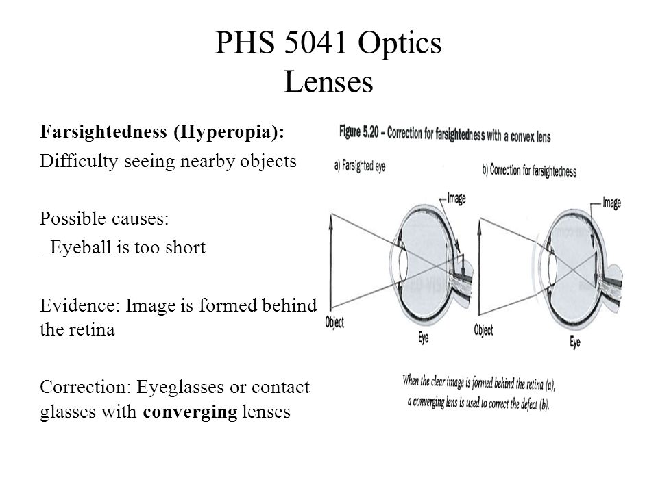 PHS 5041 Optics Lenses Farsightedness (Hyperopia): Difficulty seeing nearby objects Possible causes: _Eyeball is too short Evidence: Image is formed behind the retina Correction: Eyeglasses or contact glasses with converging lenses