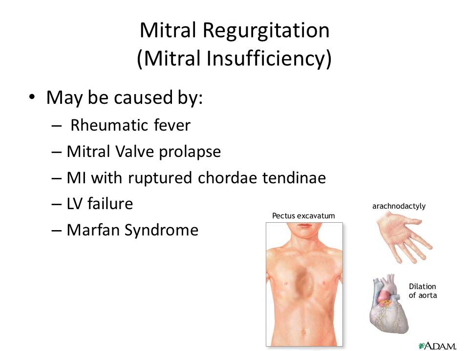 Mitral Regurgitation (Mitral Insufficiency) May be caused by: – Rheumatic fever – Mitral Valve prolapse – MI with ruptured chordae tendinae – LV failure – Marfan Syndrome