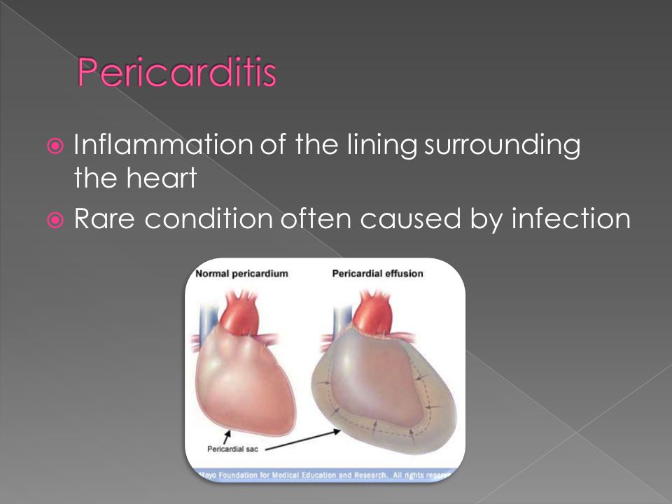  Inflammation of the lining surrounding the heart  Rare condition often caused by infection