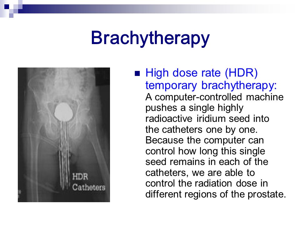 Brachytherapy High dose rate (HDR) temporary brachytherapy: A computer-controlled machine pushes a single highly radioactive iridium seed into the catheters one by one.