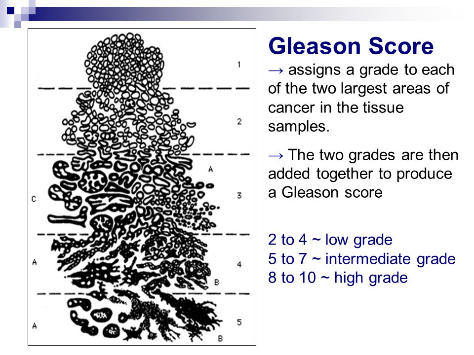 Gleason Score → assigns a grade to each of the two largest areas of cancer in the tissue samples.