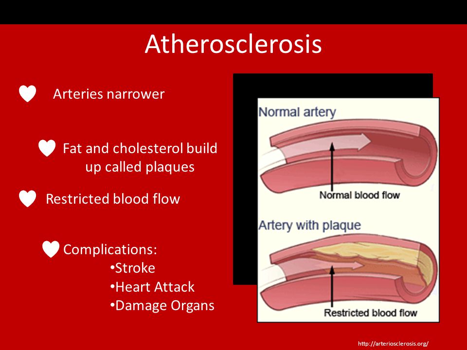 Arteriosclerosis Hardening of the arteries Arteries are no longer flexible   Can Damage Organs due to poor blood circulation