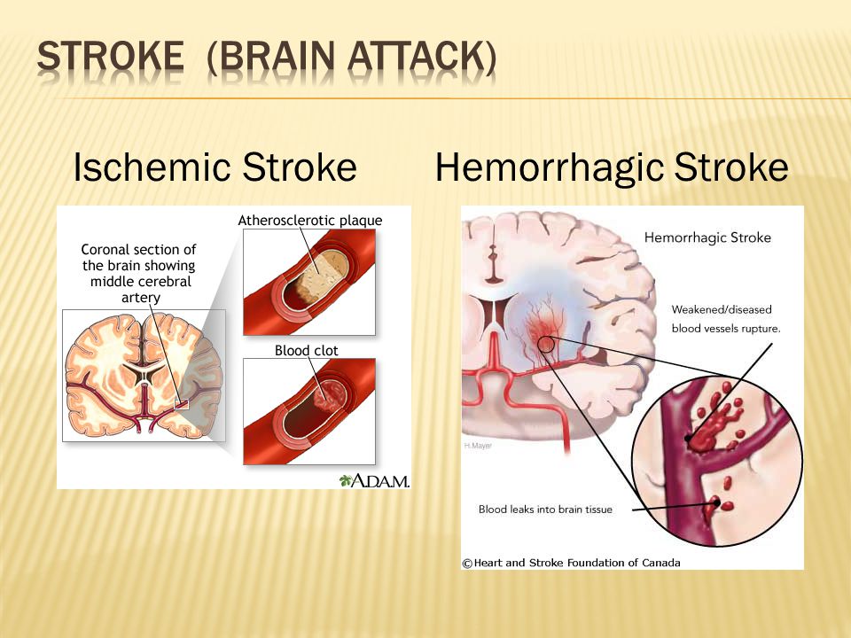 Ischemic StrokeHemorrhagic Stroke