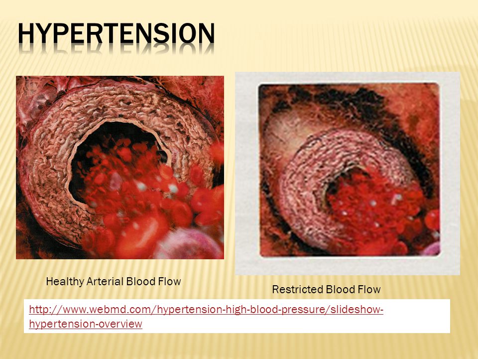Healthy Arterial Blood Flow Restricted Blood Flow   hypertension-overview