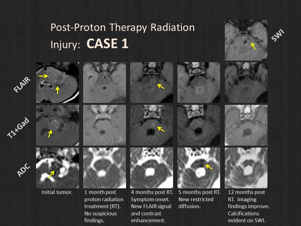 Post-Proton Therapy Radiation Injury: CASE 1 FLAIR T1+Gad ADC Initial tumor.1 month post proton radiation treatment (RT).